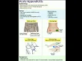 Acute Appendicitis Four signs McCBurney s Point Rovsings sign Psoas sign Obturator sign