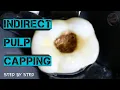 Indirect Pulp Capping||Step By Step