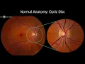 Fundus Photography Interpretation