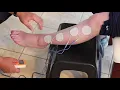 Post Stroke Foot Dorsiflexion Using Electrical Stimulation to Reduce Tone Promote Plasticity