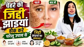 चेहरे की जिद्दी झाइयाँ जड़ से ख़त्म  करने के घरेलू उपाय | Pigmentation Treatment At Home |