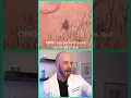 Derm reacts to HUGE ingrown hair