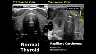 Thyroid Ultrasound Normal Vs Abnormal Image Appearances Comparison Thyroid Pathologies USG