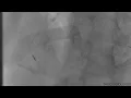 Rotational Atherectomy of Mid RCA RCA Stenosis