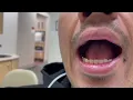 My New Gold Crown Tooth