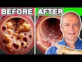 Top 10 Best Vegetables To Unclog Arteries Naturally Prevent Heart Attack