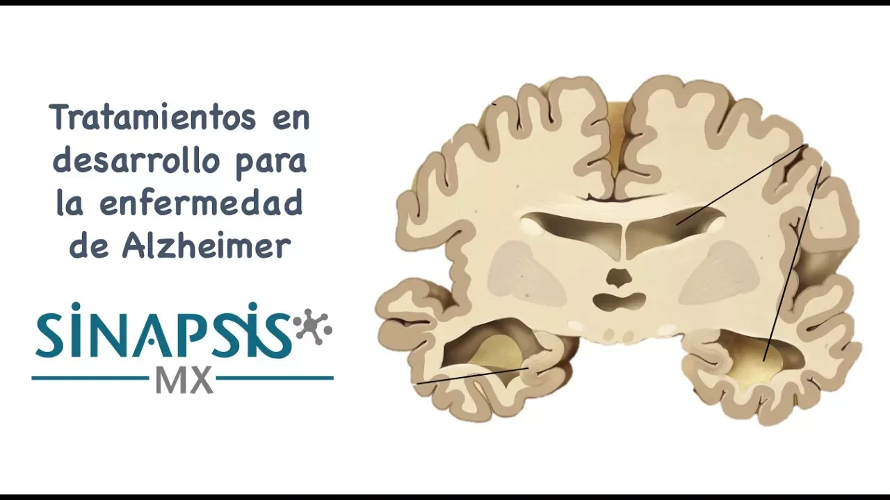 Tratamientos para la enfermedad de Alzheimer