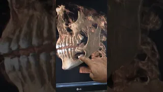 Dentigerous cyst
