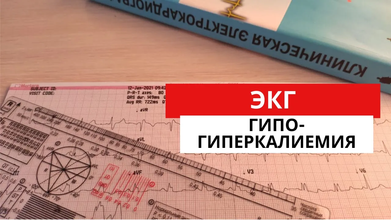 Гипокалиемия. Гиперкалиемия. ЭКГ диагностика электролитных нарушений. Физиология.
