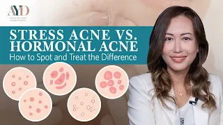 Stress Acne vs Hormonal Acne How to Spot and Treat the Difference