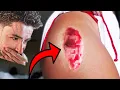 I Got Injured While Surfing in Hawaii