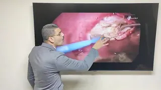 محمد صالح يشرح عملية اللوز باحدث طريقة في العالم الموسوعة محمد صلاح ثانوية عامة 