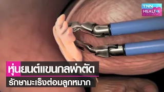 การผ่าตัดมะเร็งต่อมลูกหมากด้วยเครื่องมือแขนกลช่วยให้เกิดข้อดีอย่างไรบ้าง