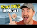 FASTEST WAY TO REMOVE WARTS Painlessly and Safely Chris Gibson