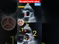 Echo of Bicuspid Aortic valve l short axis view l