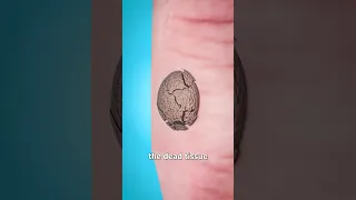 How Warts Are Frozen Off