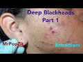 Deep waxy pore plugs removed 20 minutes of extractions with MrPopZit