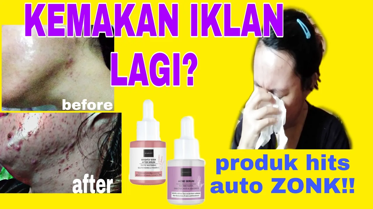 28 HARI COBA SKINCARE UNTUK SENSITIVE ACNE PRONE SKIN - Kulit Sensitif yang Mudah Berjerawat. 
