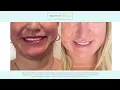 Rejuvenate Renew Before And After Slideshow