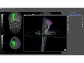 BrainMagix 2 1 Constrained Spherical Deconvolution CSD -based Tractography