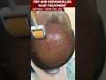 Download Lagu Here's What People Are Saying About PRP And Derma Roller Hair Treatment. #PRP #derma_roller #shorts