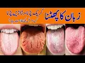 Lagu Zuban ka phatna/crack prna | Zuban ka kharab hona | Tounge Cracked causes by Hakeem Haseeb Bhatti