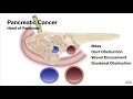Download Lagu HCC 1474 3c Cancer Pancreas Head