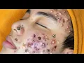 Loan Nguyen Acne Treatment specal 6