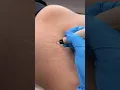 Stretch Marks Inkless Removal Boleyn Treatment Los Angeles