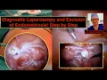 Diagnostic laparoscopy Step by Step - Excision of Endometriosis