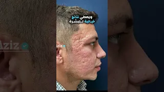 تقشير الوجه باستخدام الفينول دندنها