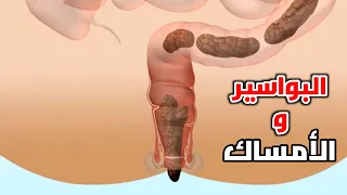 شاهد كيف تحدث البواسير How Do Hemorrhoids Occur 
