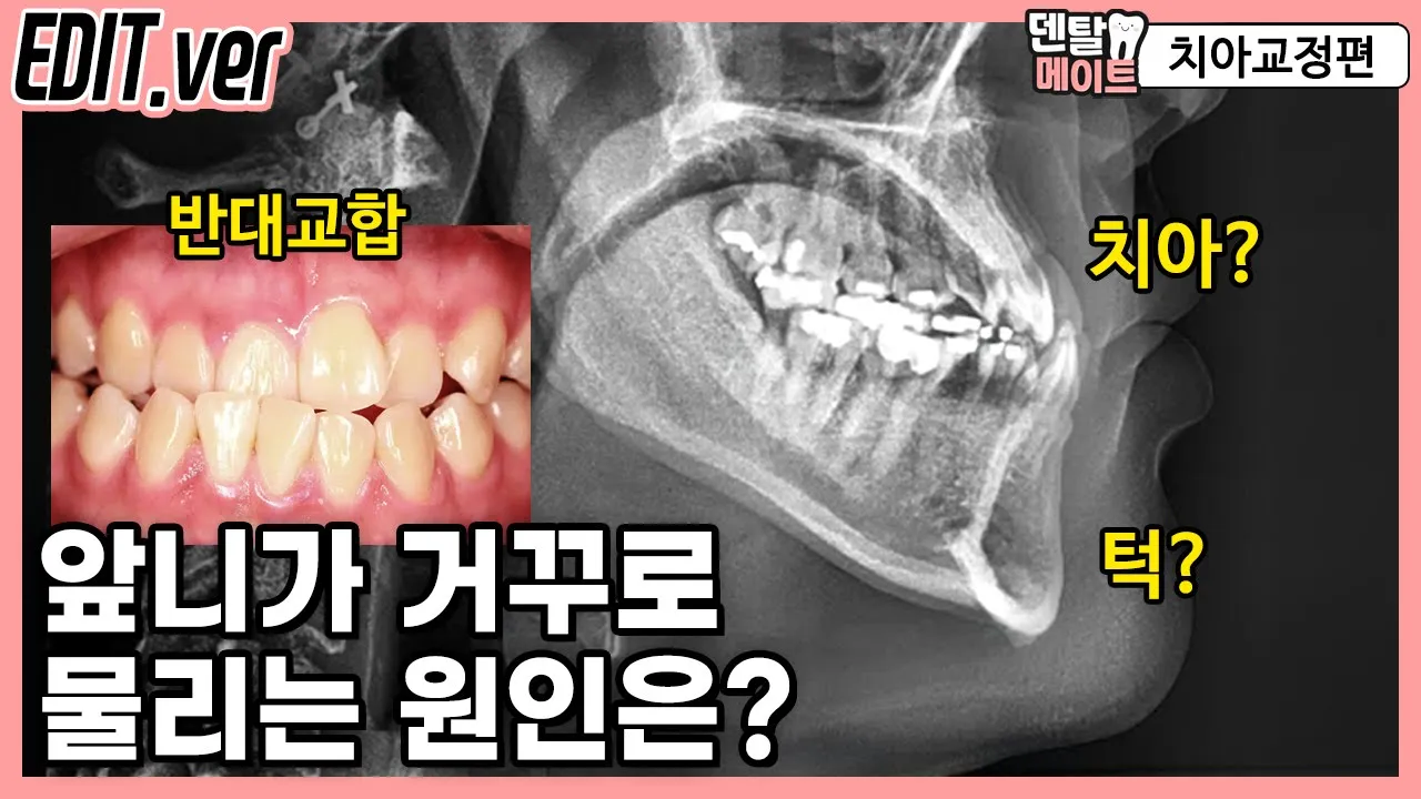 거꾸로 물리는 앞니, 반대교합의 원인을 분석하는 기준 (턱의 원인, 치아의 원인, ANB각도)