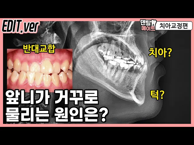 거꾸로 물리는 앞니, 반대교합의 원인을 분석하는 기준 (턱의 원인, 치아의 원인, ANB각도)