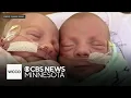 Minnesota woman gives birth to ultra rare mono mono twins