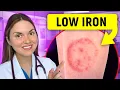 14 Signs of IRON DEFICIENCY You Can See Doctor Explains