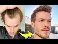 Download Lagu My Turkey Hair Transplant 4 Month Update | Before \u0026 After