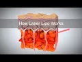 How Laser Lipo Works to Release Fat and Reduce Cellulite