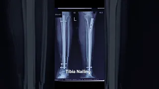 التحميل علي الساق بعد المسمار النخاعي دكتور نادر كميل 