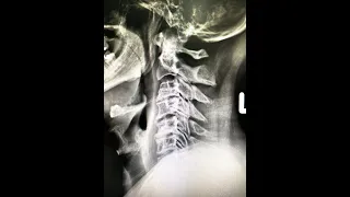  อาการปวดคอและไหล่ในผู้สูงอายุอาจเกิดจากอะไรบ้าง 