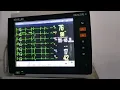 case of Ventricular Bigeminy changing to Trigeminy and Quadrigeminy