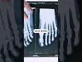 5 symptoms of calcium deficiency