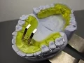 Download Lagu Vorschubdoppelplatte, Angle II, Sander II, Doppel-Vorschubplatte, Double Plate, KFO, Orthodontics