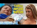 Dr Dubrow RUPTURES Ilana s 2300cc Implants On Purpose Before After Botched E