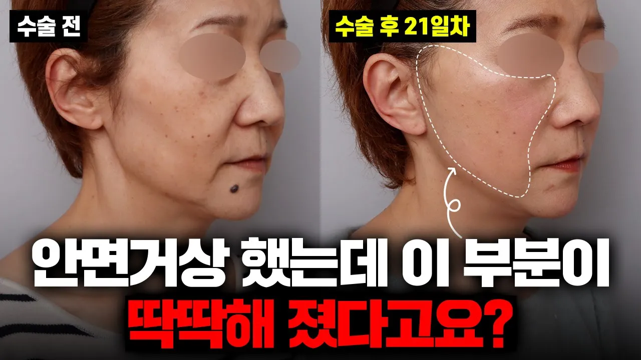안면거상 후 피부가 딱딱해졌다? 혹시.. 부작용?!😱