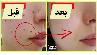 ۳ روش راحت و سریع برای از بین بردن خال 