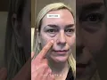 4 Months After Quadfecta Lift with Dr Kami Parsa Upper and Lower Blepharoplasty