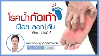  น้ำกัดเท้าเกิดจากสาเหตุอะไรบ้าง และมีอาการอย่างไร 