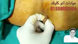 إزاله البواسير الخارجية بالليزر أ د وائل متولى 