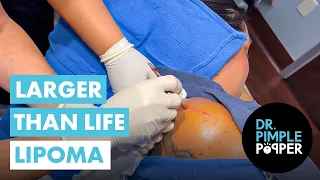 Larger Than Life Lipoma that Dr Pimple Popper Couldn t Believe